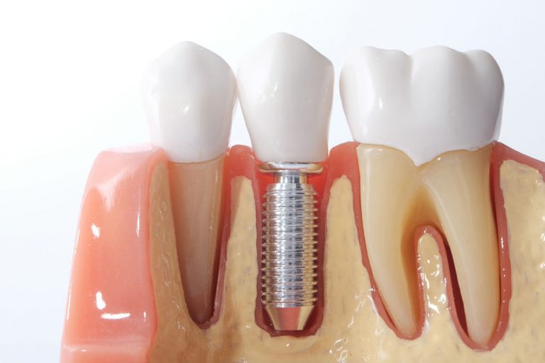 peri-implant-health-peri-implant-disease-case-definitions-and