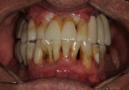 The New Classification of Periodontal Disease and Peri-implant Disease