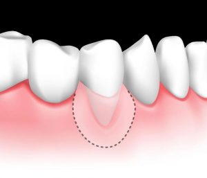 Bone & Gum Grafting Toronto | Periodontal Grafts | Dr. Jon Perlus